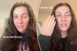 Stunned patient shares terrifying Botox experience that left her scarred: ‘Gonna have to be a pirate for Halloween’