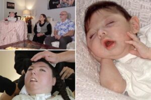 Woman born with no brain turns 20 in medical ‘miracle’ — told she’d never make it to 5