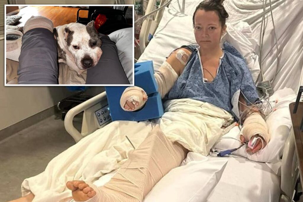 Tennessee mom loses leg in attack by her own pit bull that left limb ‘basically hanging off’