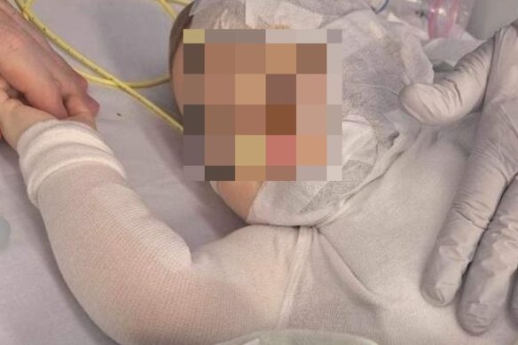 Luka was seriously scalded and underwent multiple operations to treat burns to his face, neck and chest. 