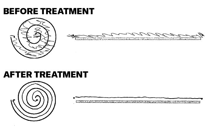 An illustration of how patients were able to draw before being administered high-intensity focused ultrasound treatment, which are mostly shaky lines; and how patients drew after, which are mostly straight lines.