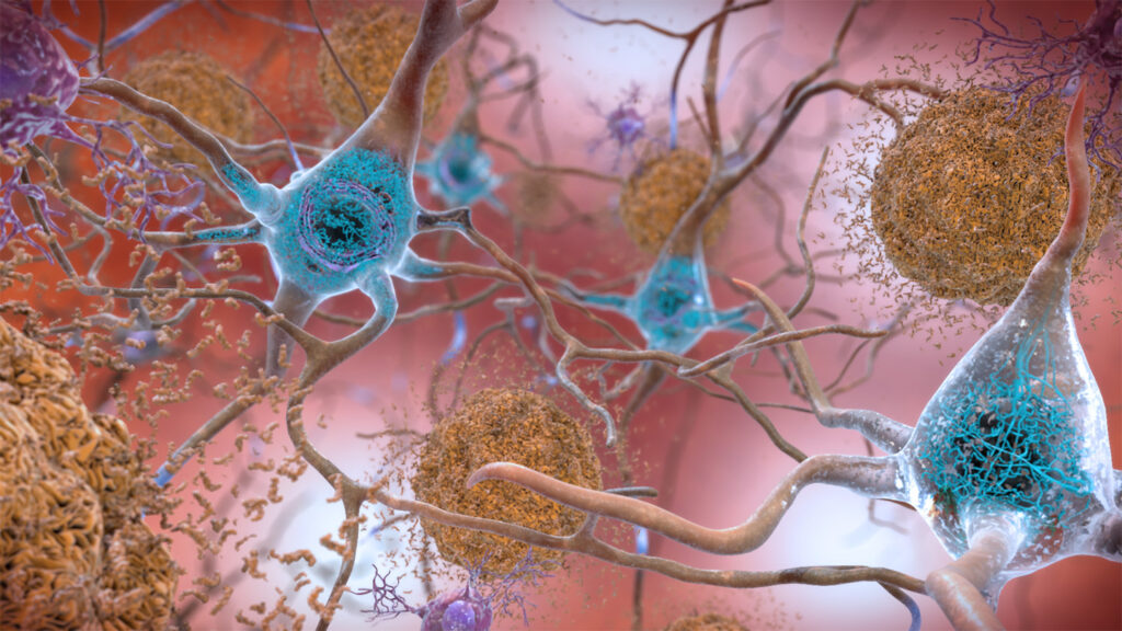 A new sort of Alzheimer’s drug shows glimmers of promise