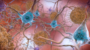 A new sort of Alzheimer’s drug shows glimmers of promise