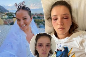 Bride-to-be sounds alarm after popular $88 beauty treatment left her almost blind before the big day