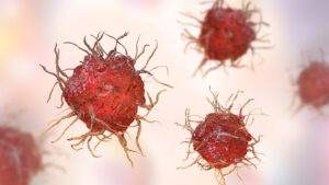 Alzheimer’s damage may begin outside the brain
