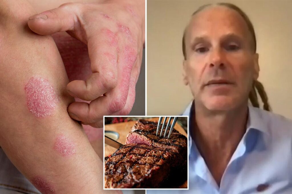 Florida man says meat-only ‘lion diet’ cleared psoriasis, ended decades of depression
